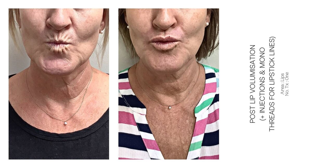 Best South Coast Lip Injection Before and After 54