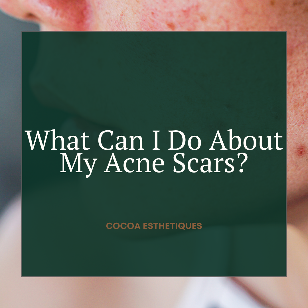 acne-scars (1)