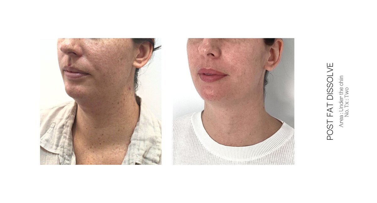 Under Chin Fat Dissolve Before and After 4