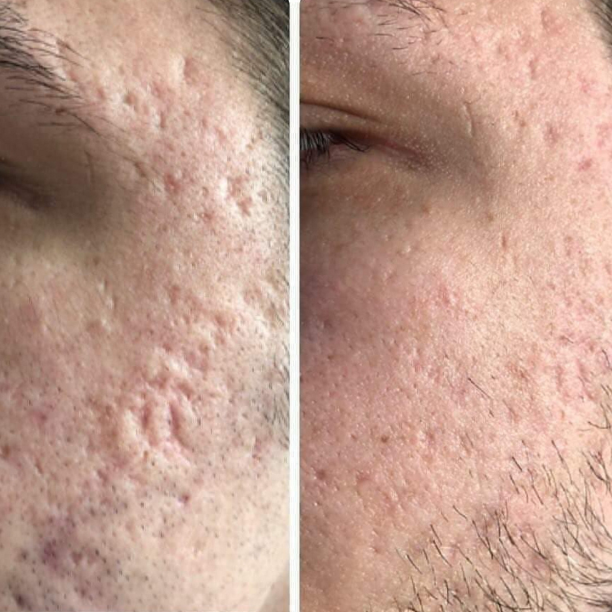 Acne Scars