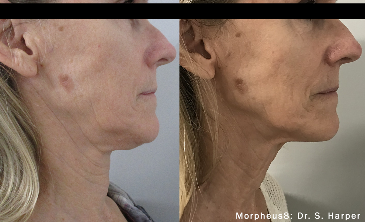 morpheus8-before-after-dr-s-harper-preview-3