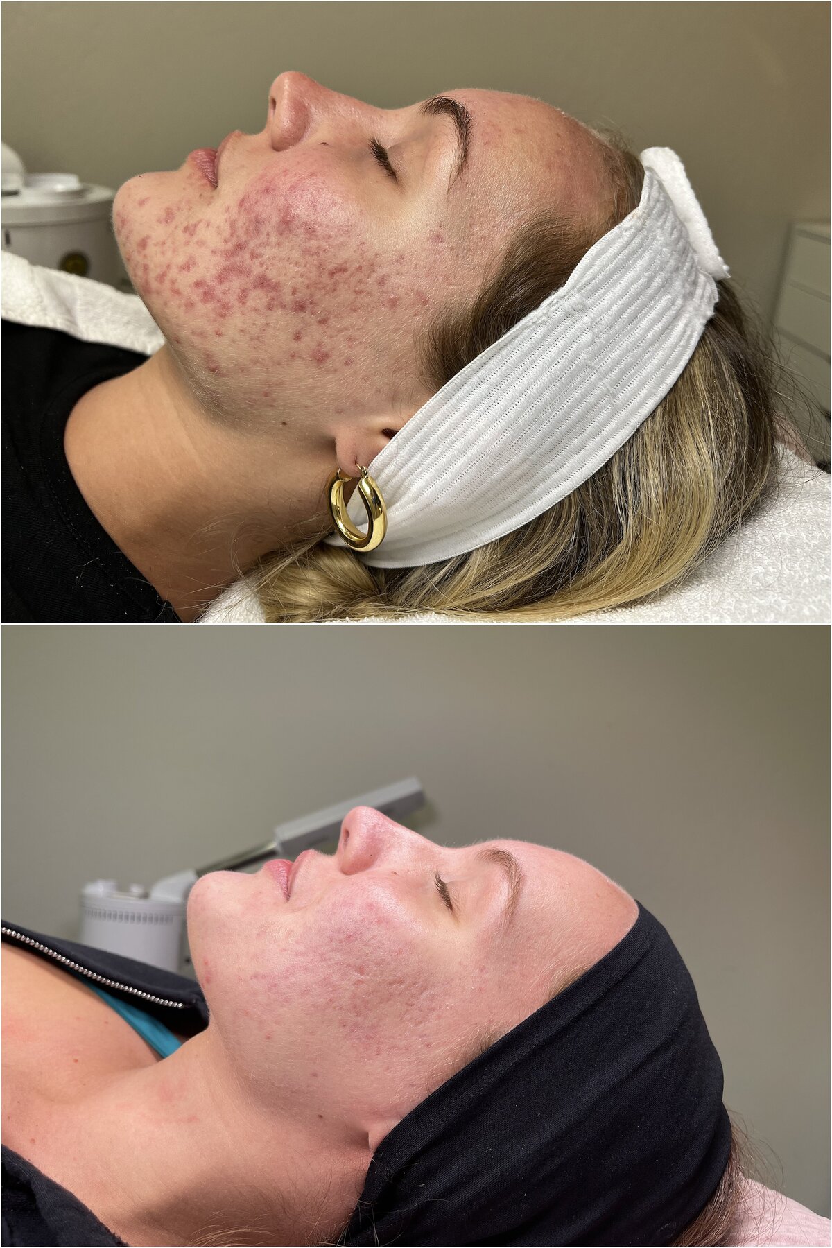 MK Studios_Allure AZ_acne-treatment-flagstaff-az-before-after_0021