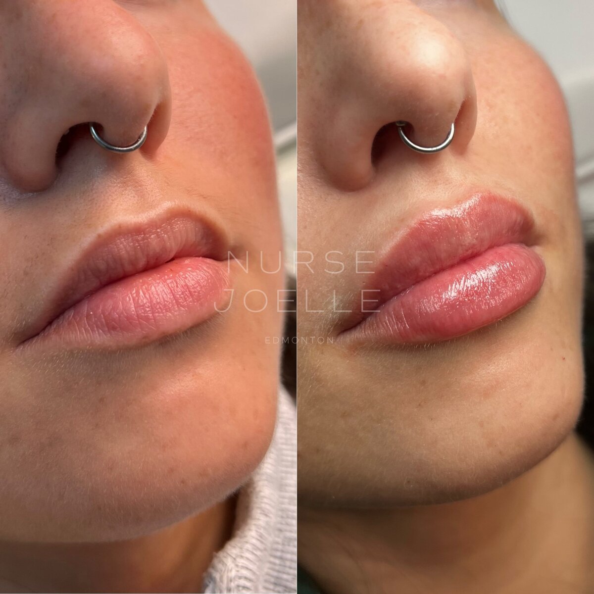Nurse-Joelle-Lip-Filler-Before-After