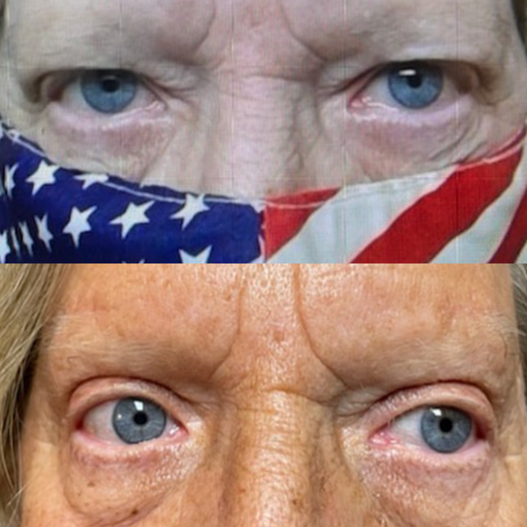 Direct Brow ptosis repair and bilateral blepharoplasty