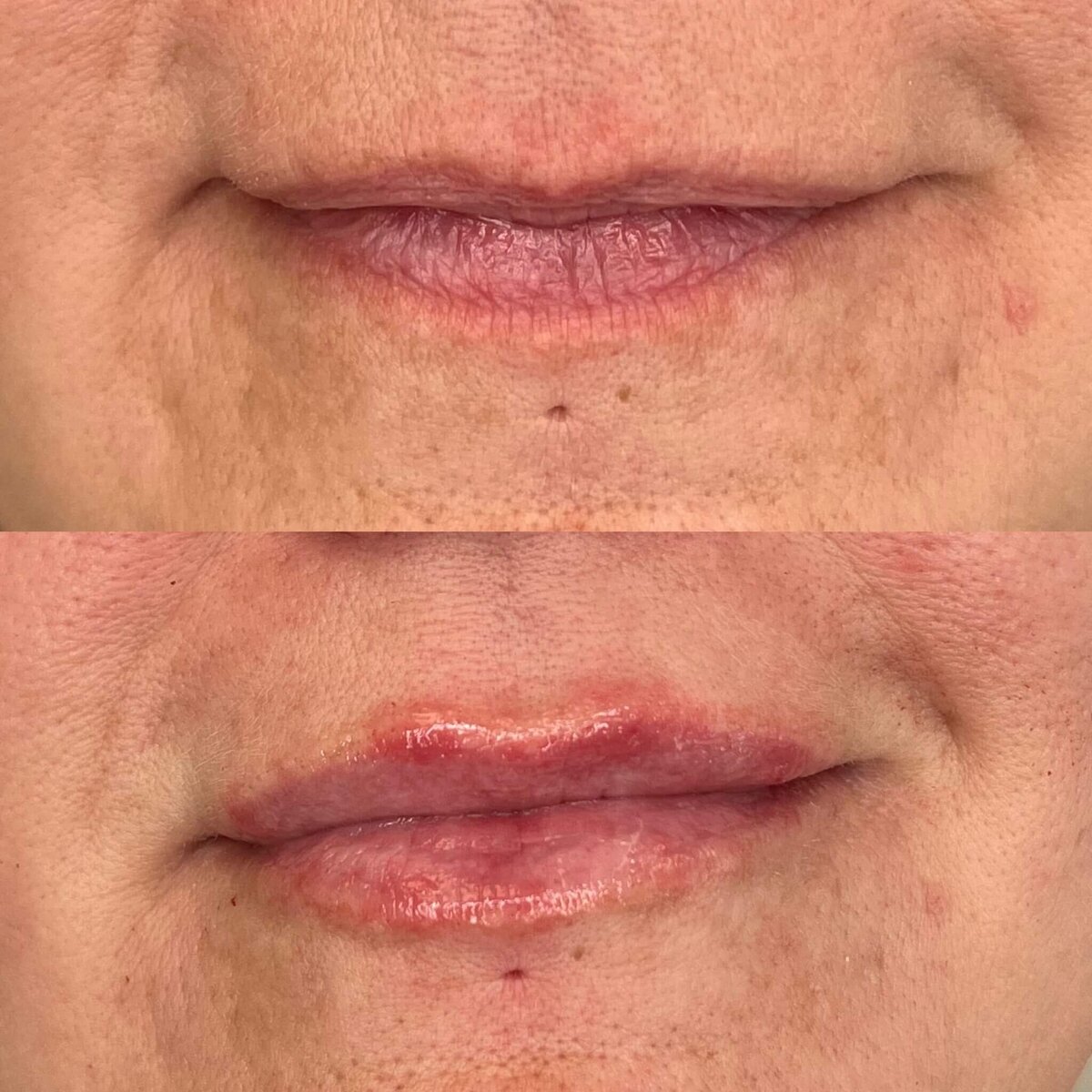 before-after-results-lip-fillers-toronto