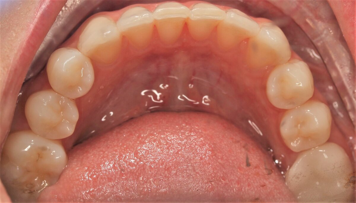 lower straight teeth allen texas