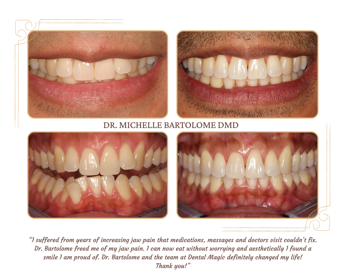 Clear Aligners