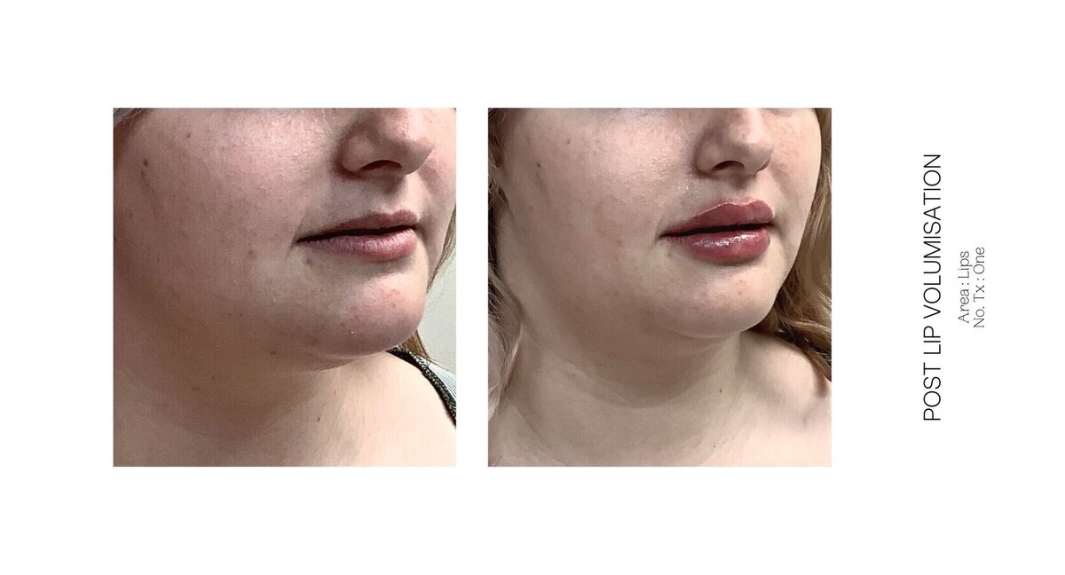 Best South Coast Lip Injection Before and After 39