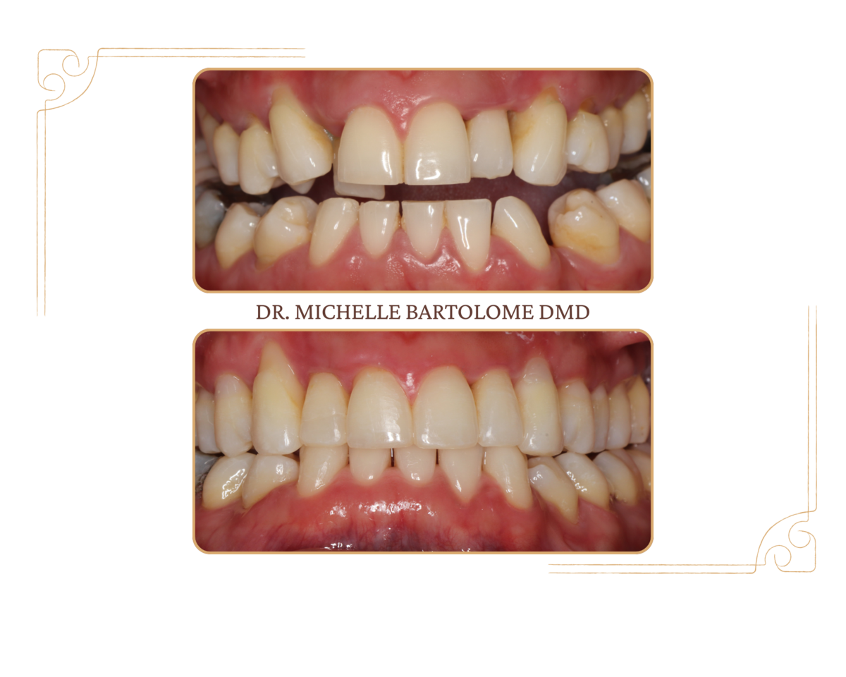 Clear aligners