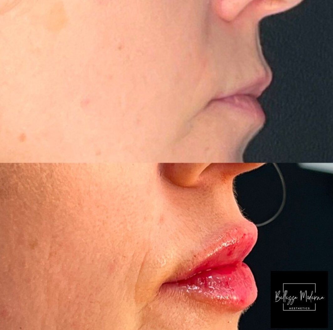 immediately after lip filler