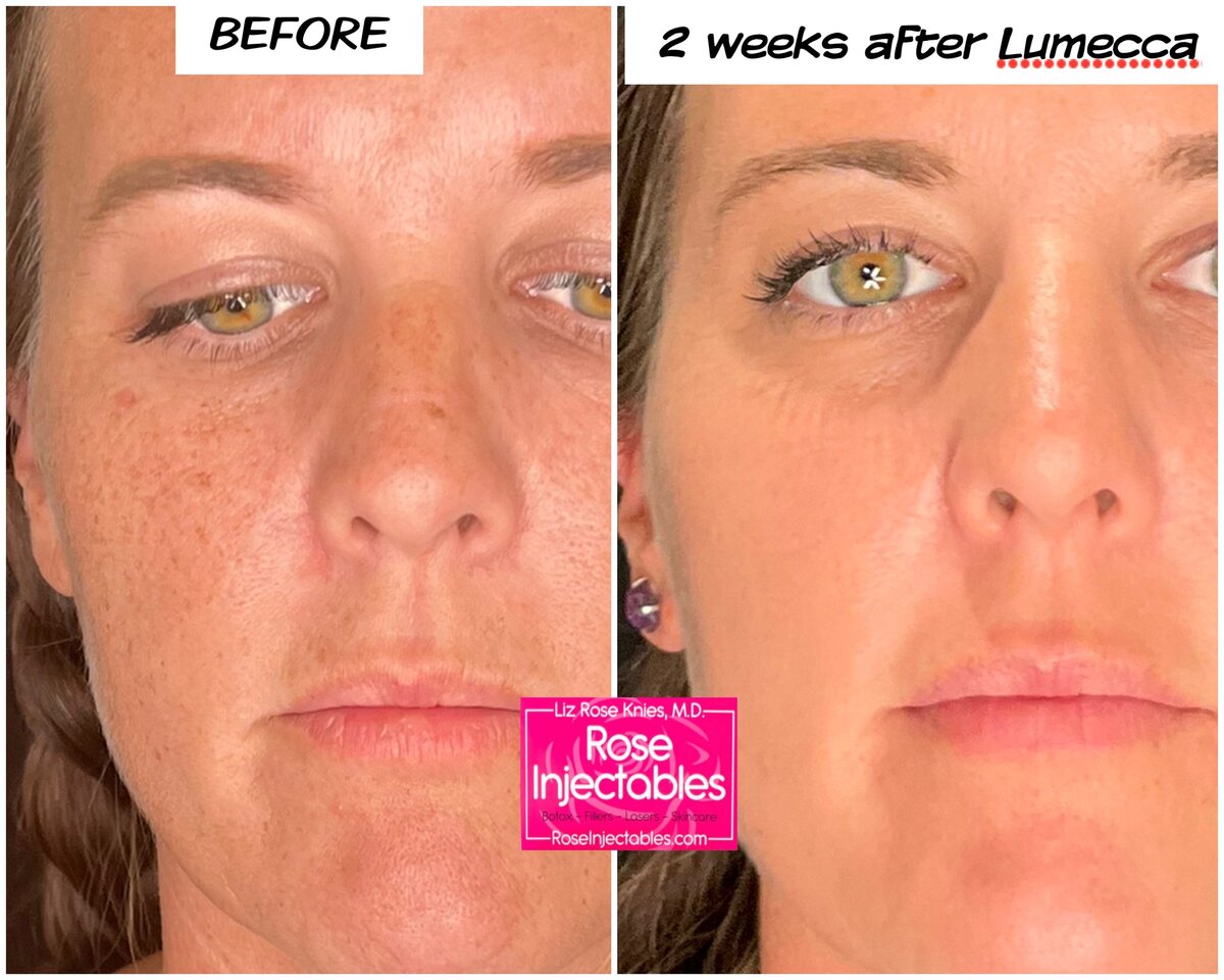 Lumecca-by-Rose-Injectables-Dark-Spot-Removal-Before-and-After-Photos-27