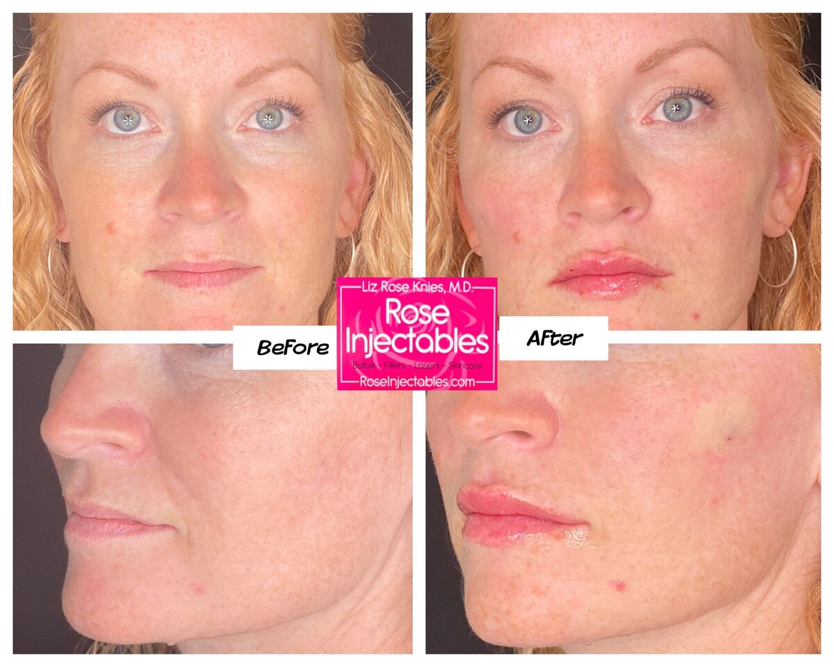 Fillers-by-Rose-Injectables-Before-and-After-Photos-31