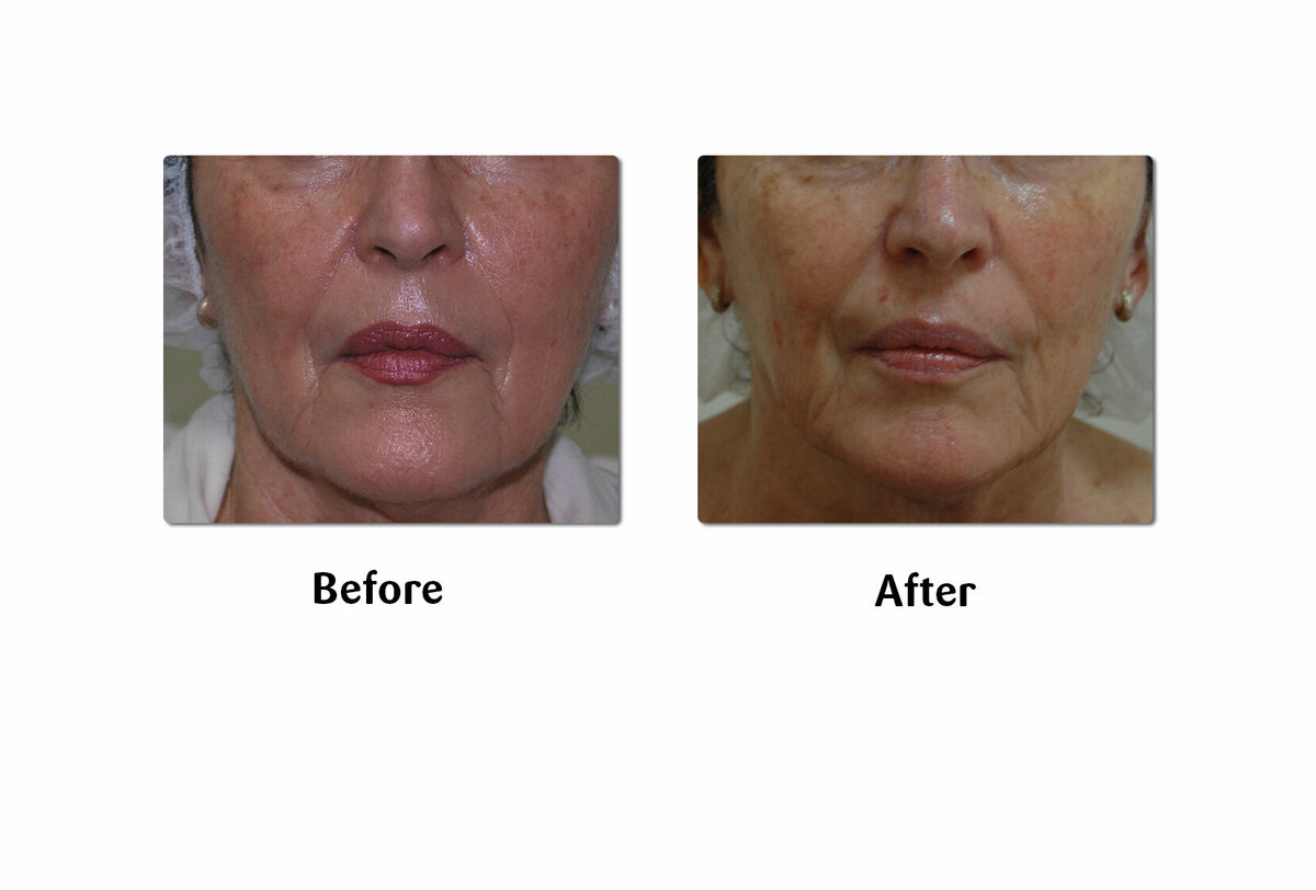 Li Medical Aesthetics Skin Tightening with VST Sinclair Before and After1
