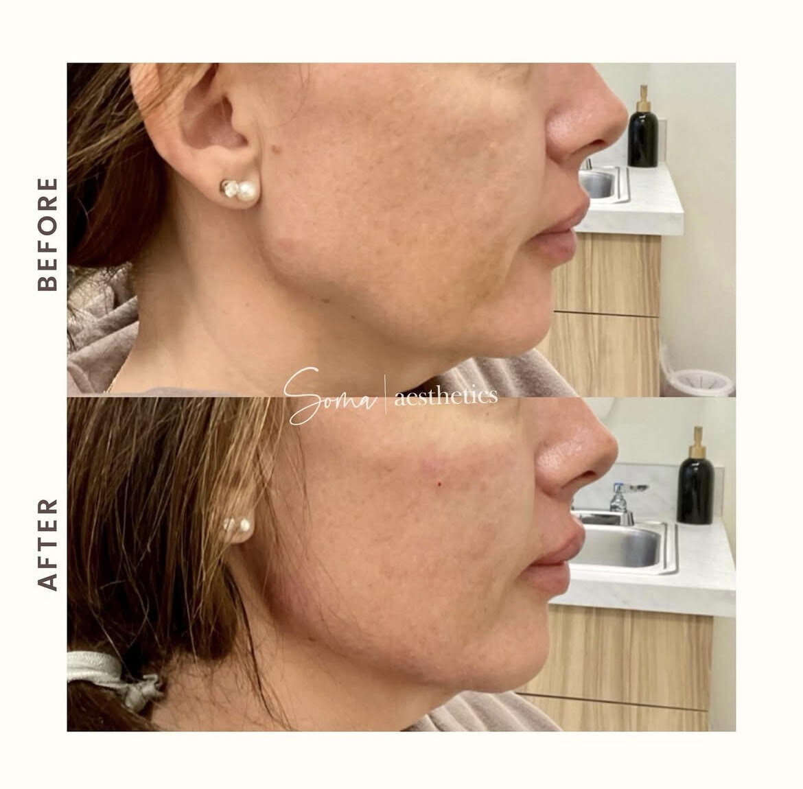 Jawline & cheek filler 