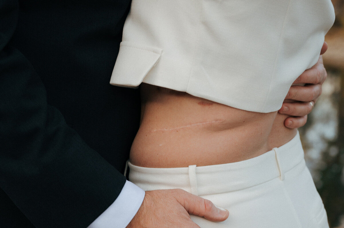 A man embracing a woman, her  waist is exposed showing a scar along her side.