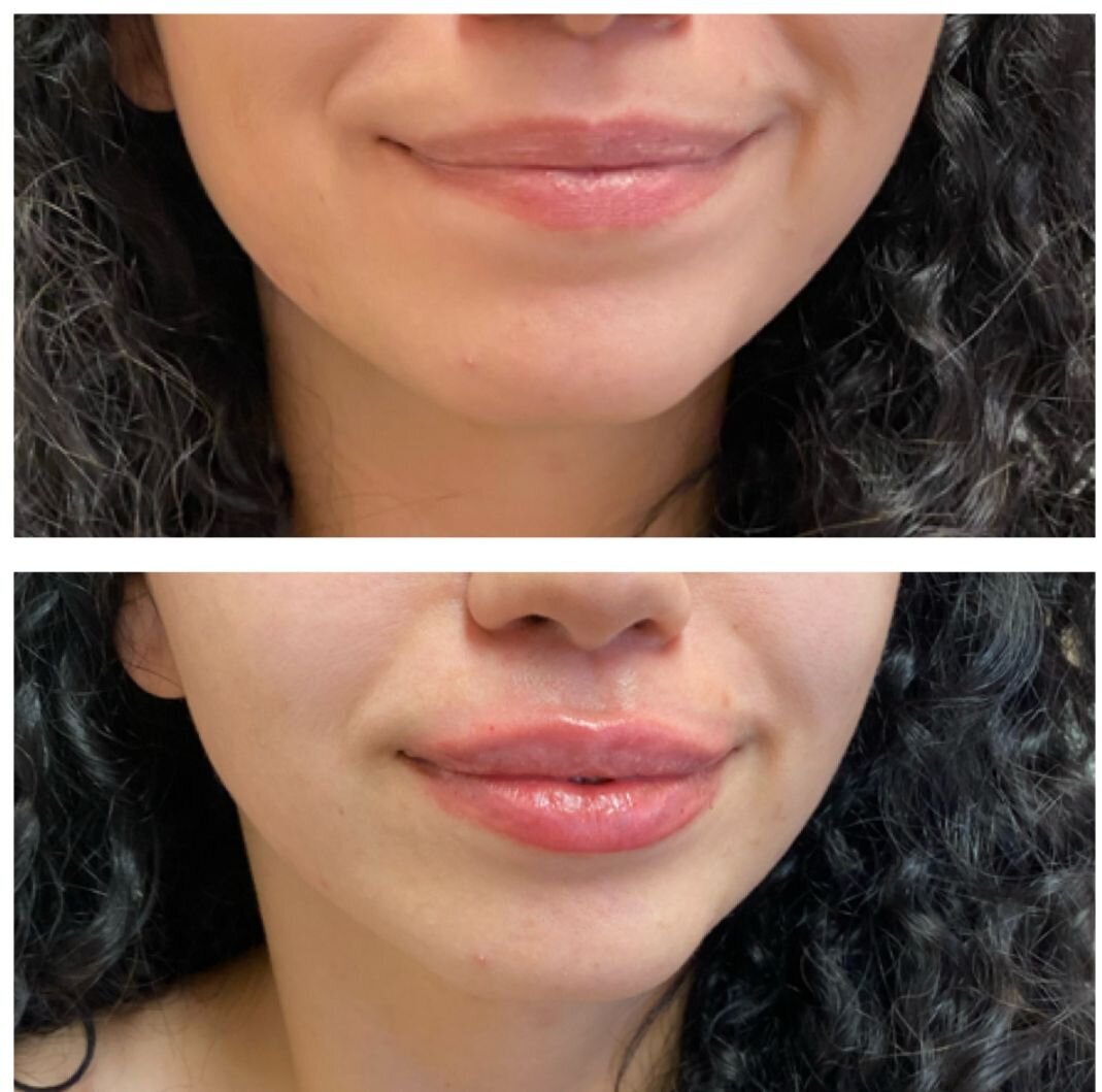 compressed-Lip-Wrinkles- Lip-volume-nd-some-brand-pics-05