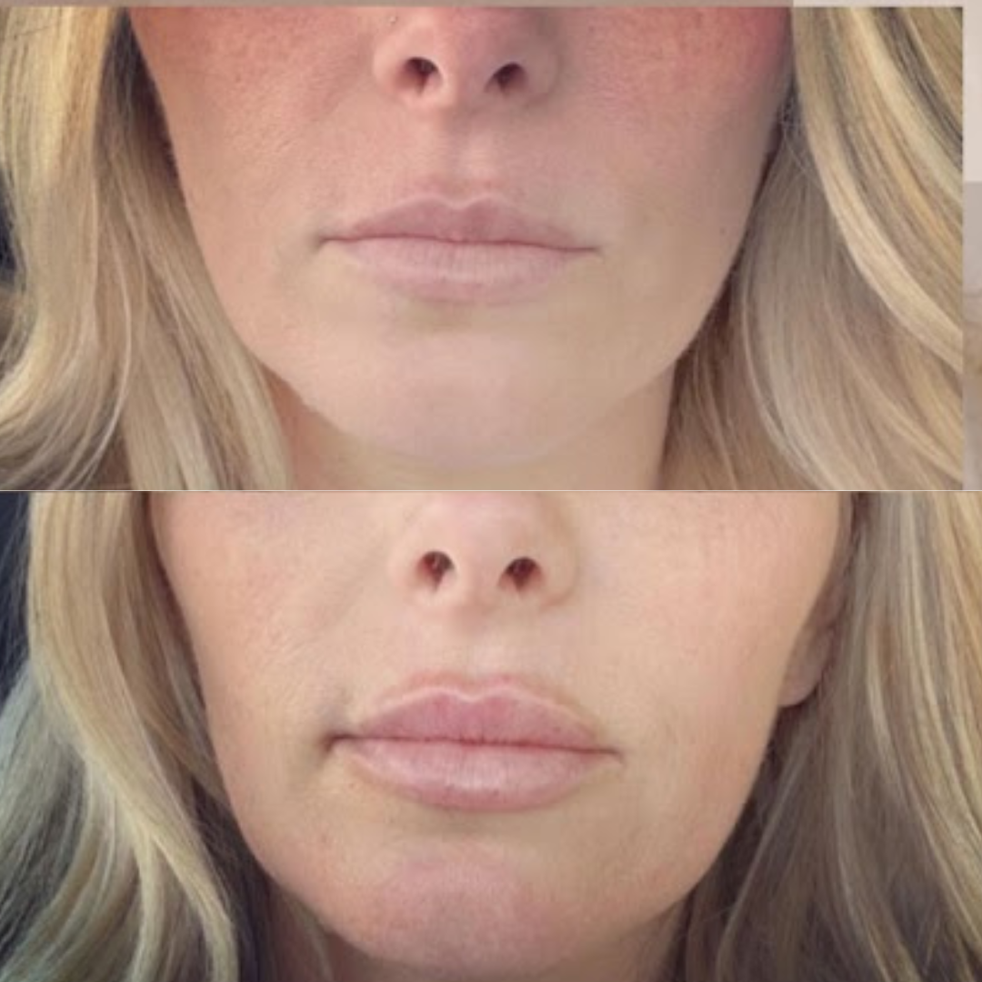 Botox BeforeAfter (1)