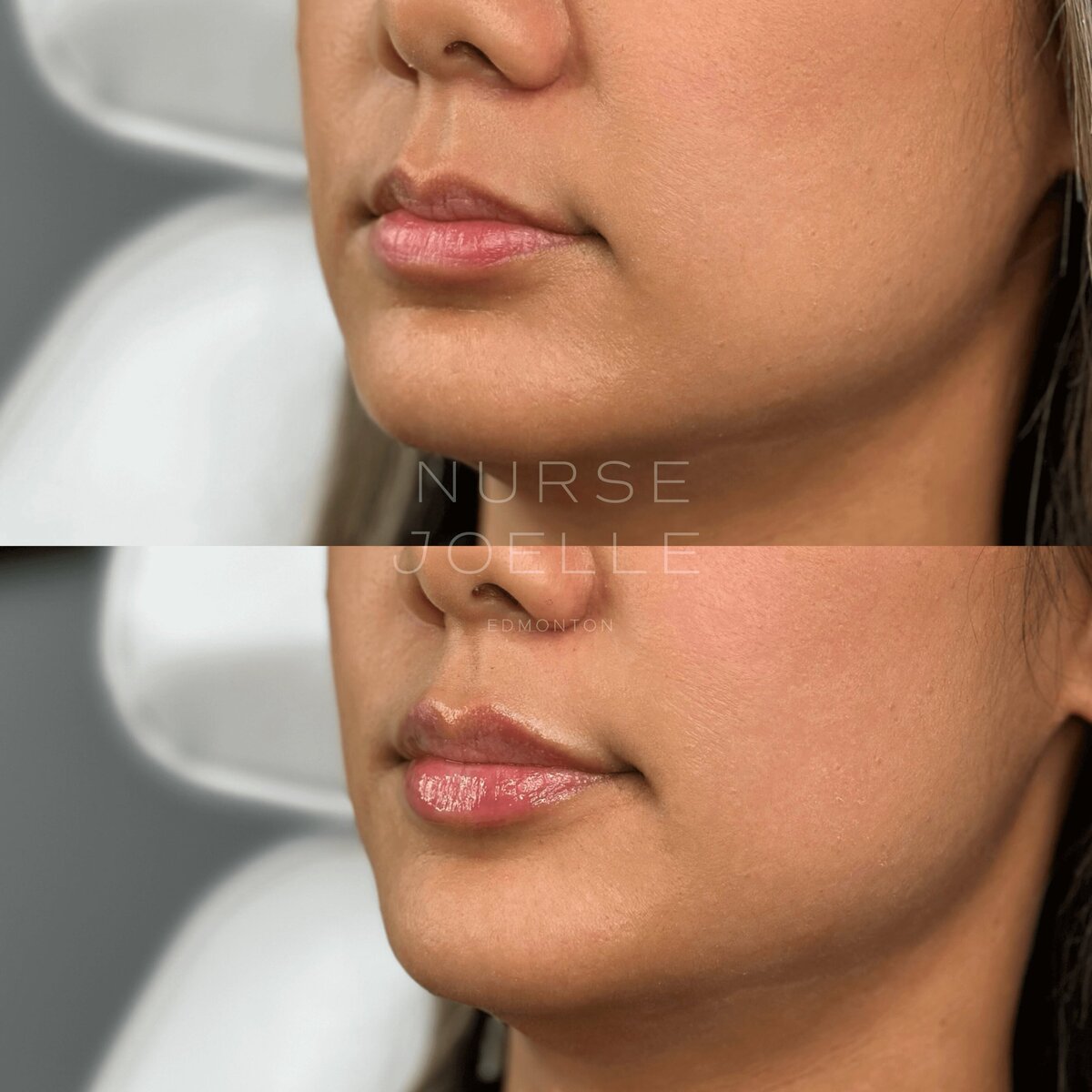 Nurse-Joelle-Cosmetic-Injectables-Before-and-After-2