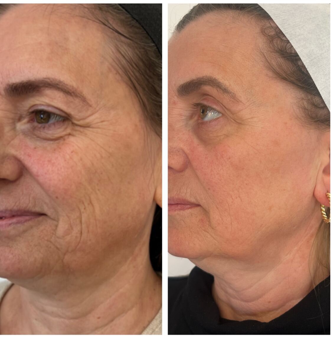compressed-halo-before-after-04