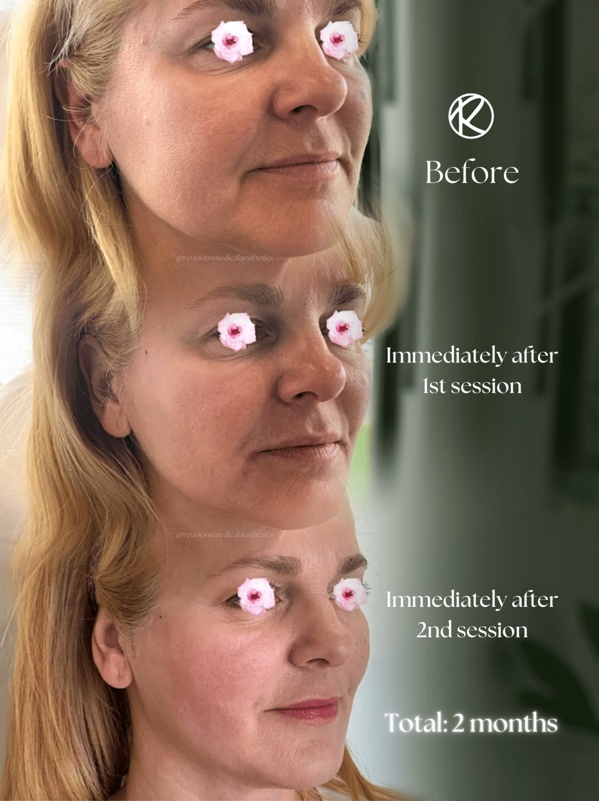 Best_Thread_Lift_in_Ottawa_Healed (1)