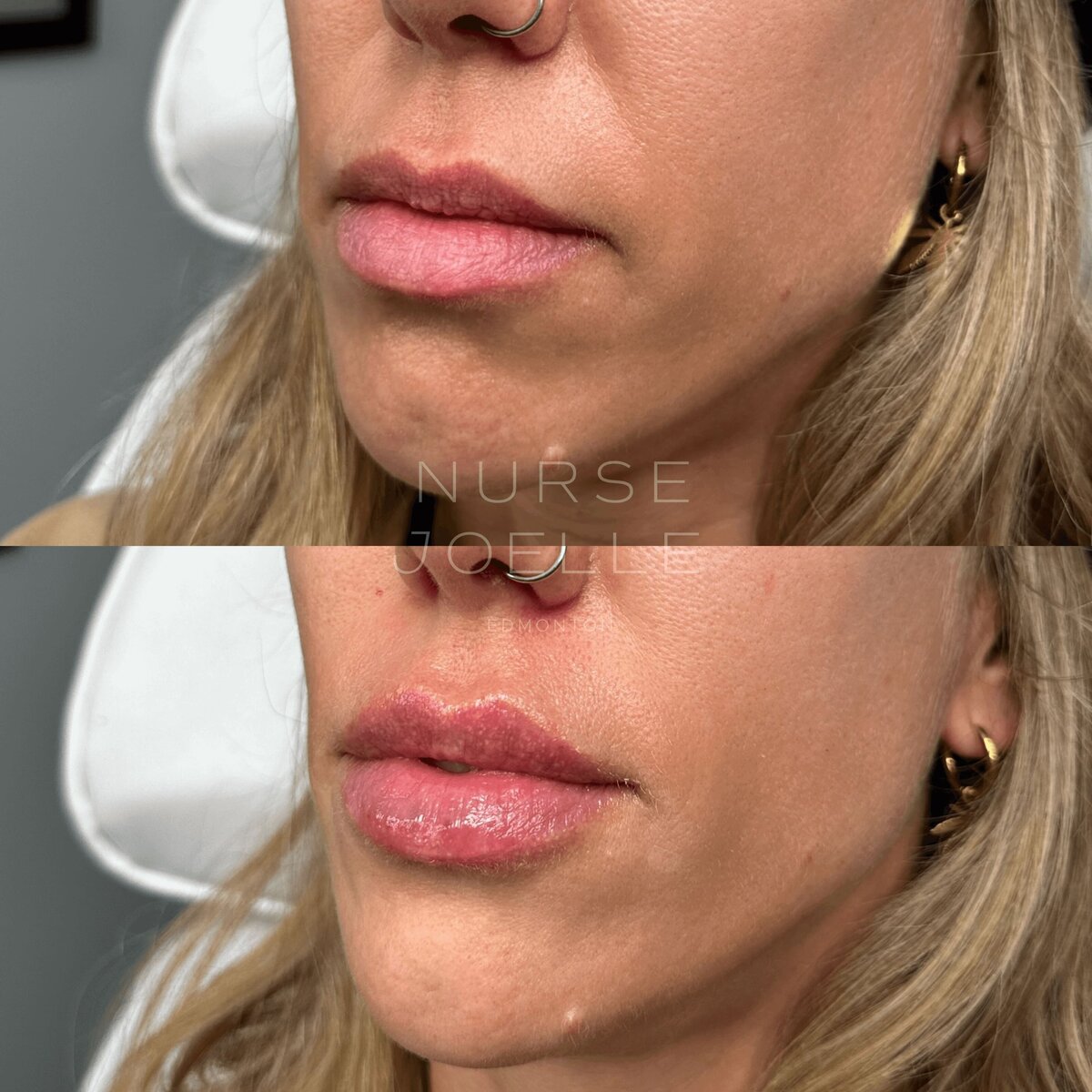 Nurse-Joelle-Cosmetic-Injectables-Before-and-After-16