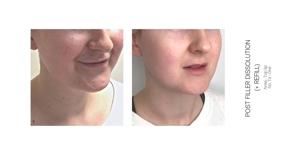 Top Lip Filler Dissolve Before and After 7