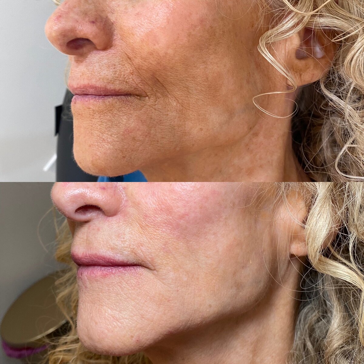 BalancedBeautyBotoxWestwood20