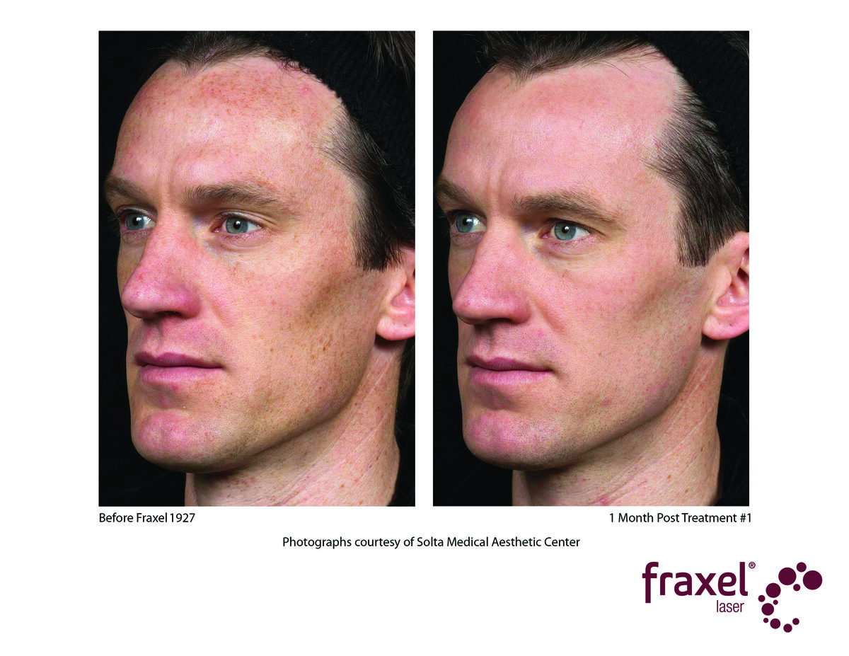 0405-Fraxel_1927_HiRes