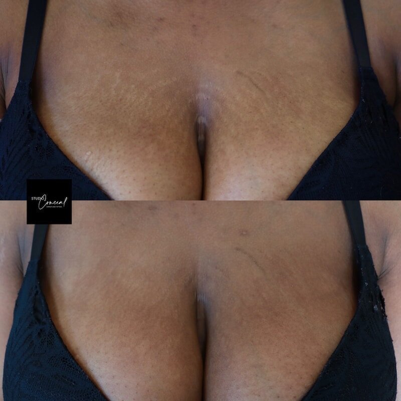 inkless-stretch-mark-camoflage-breasts