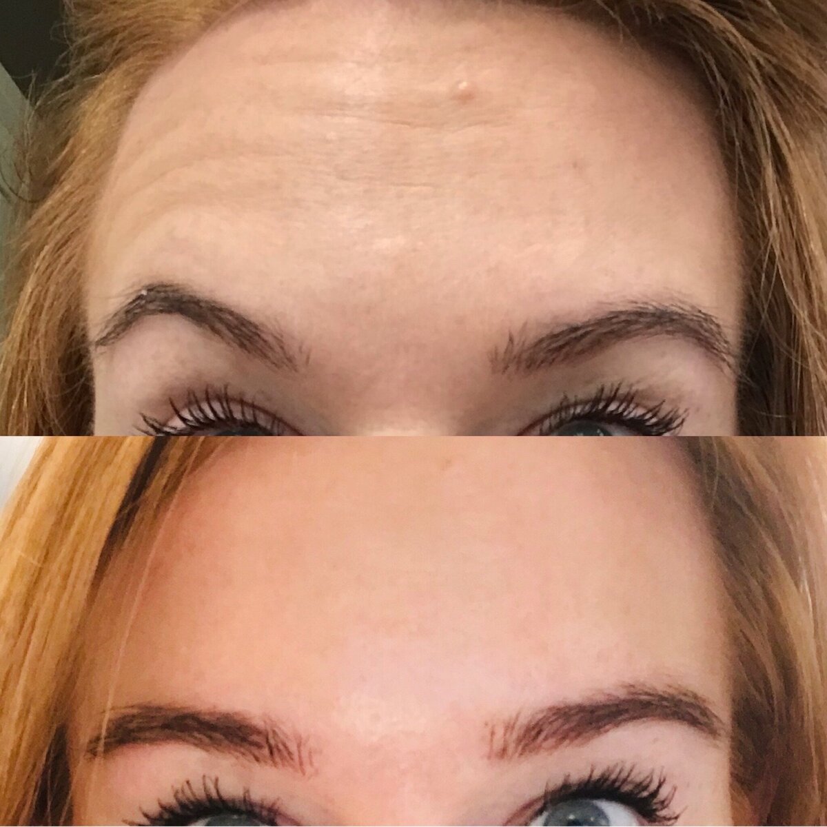 BalancedBeautyBotoxWestwood32