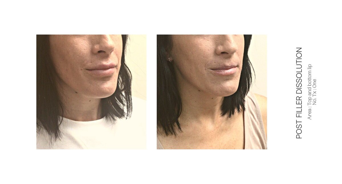 Lip Filler Dissolve Before and After 2
