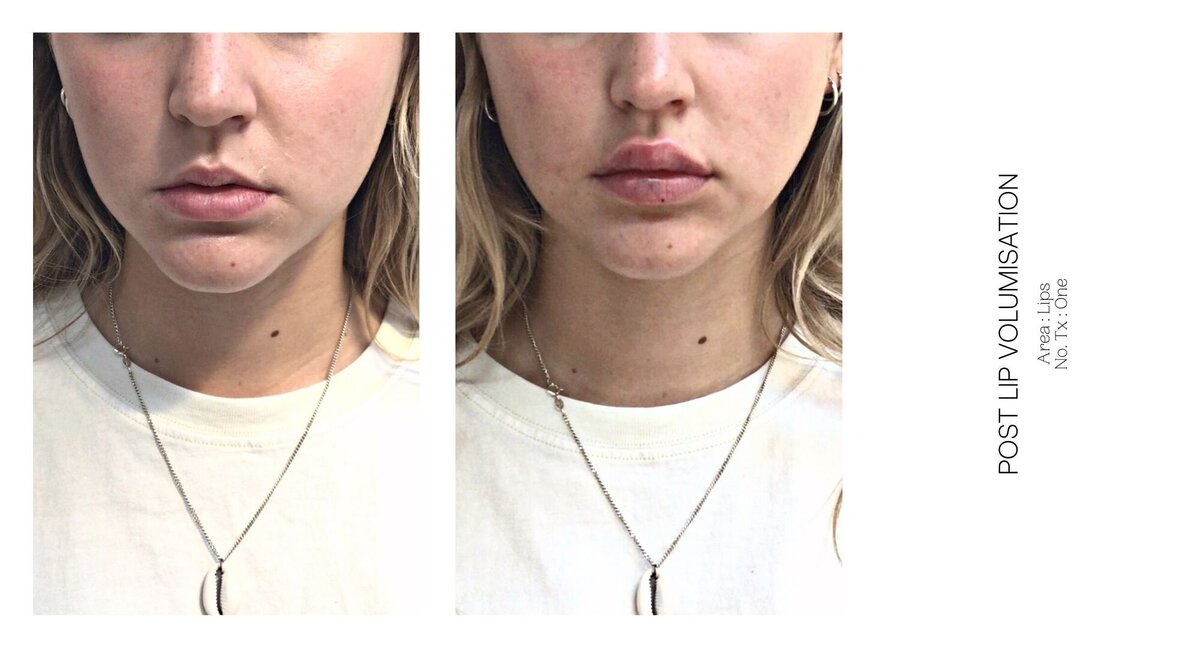 Best South Coast Lip Injection Before and After 27