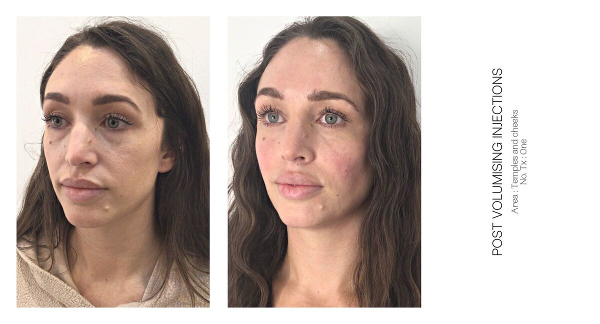 Cheek Injectable Before and After 10