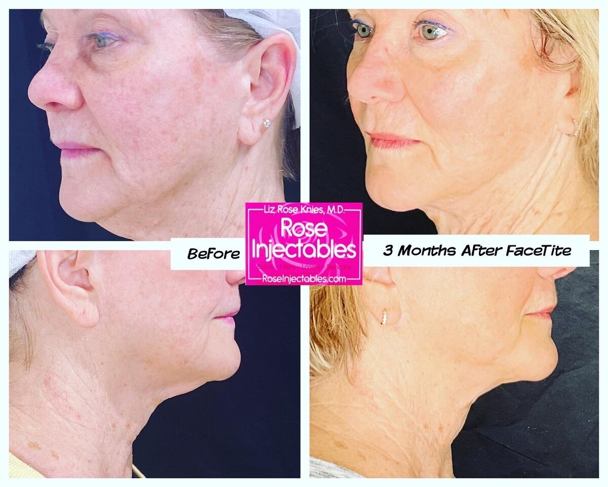 FaceTite-by-Rose-Injectables-Minimally-Invasive-Face-Contouring-Before-and-After-Photos-2