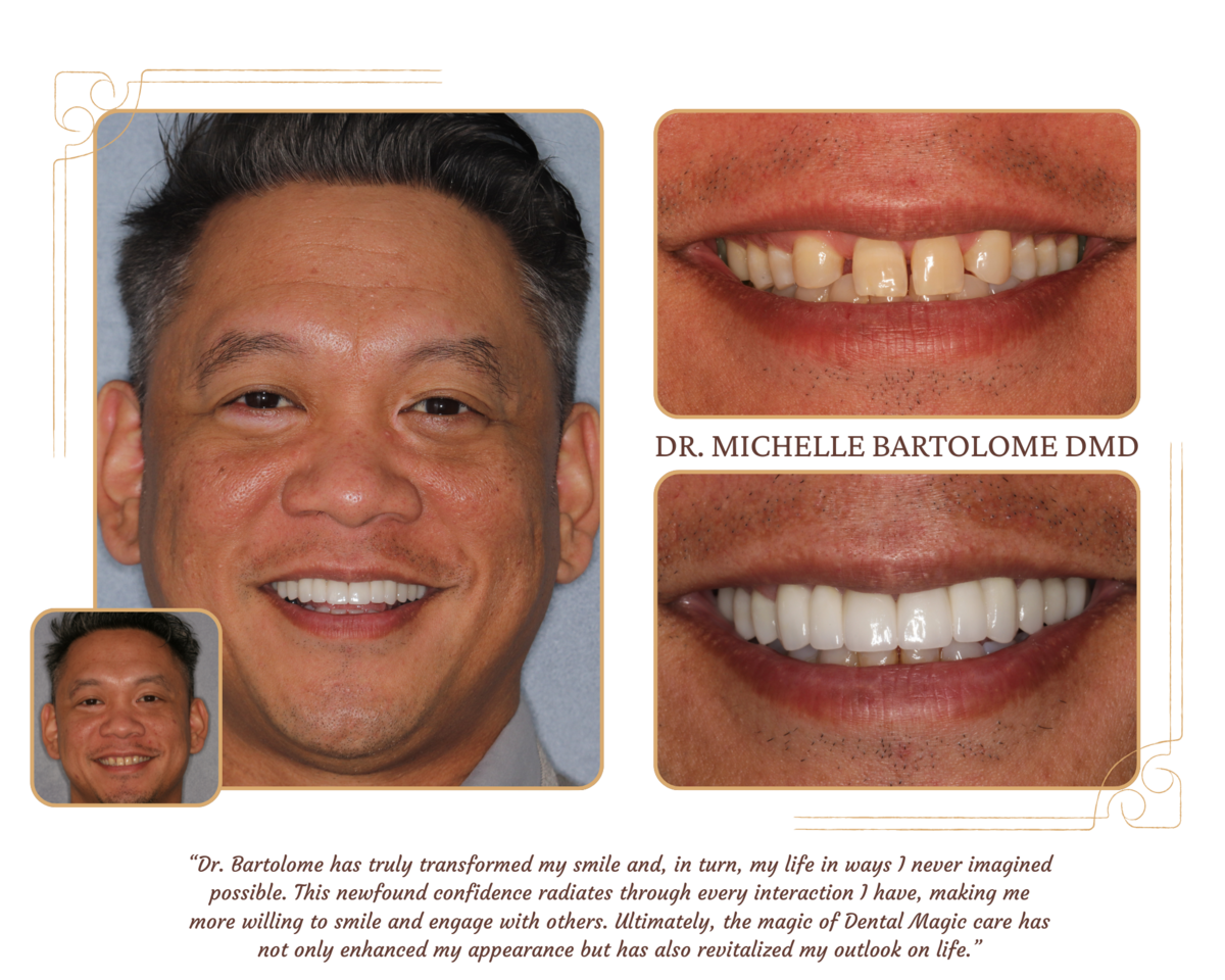 Missing Teeth