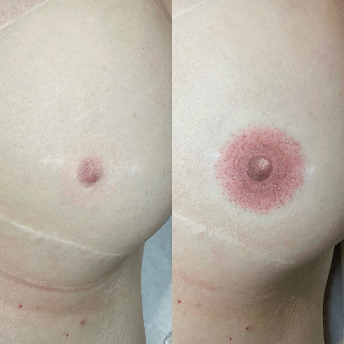 Paramedical Tattoo Mastectomy Scar by Vamp Cosmetic