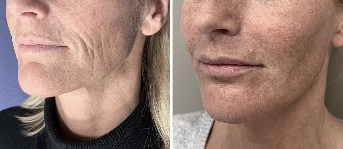 Filler mondhoeken door cosmetisch arts Lizenka Adriaanse in Rotterdam