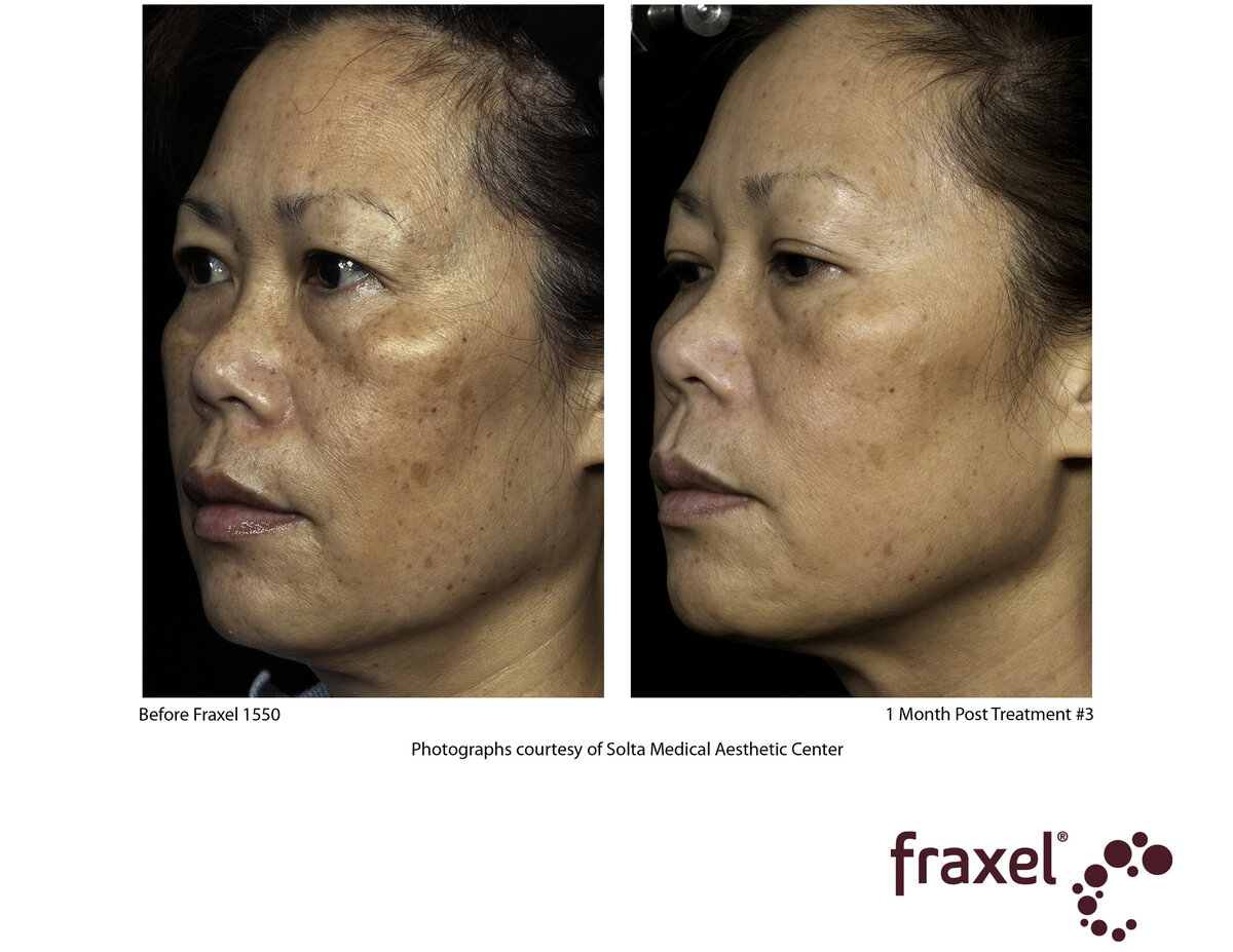 E001-Fraxel_1550_HiRes