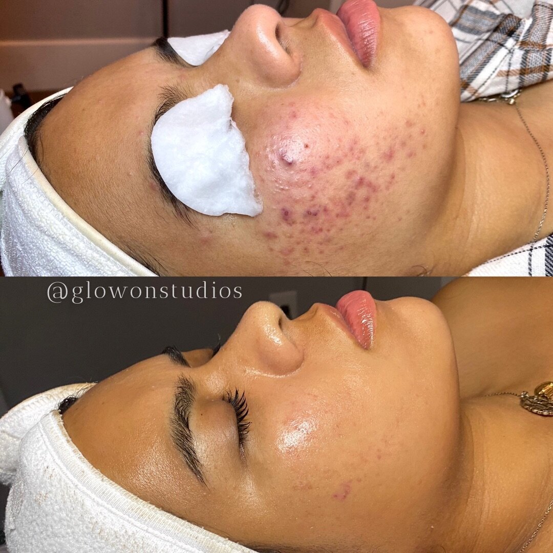 Glow-On-Studios-Before-After-Skincare-Sacramento-3