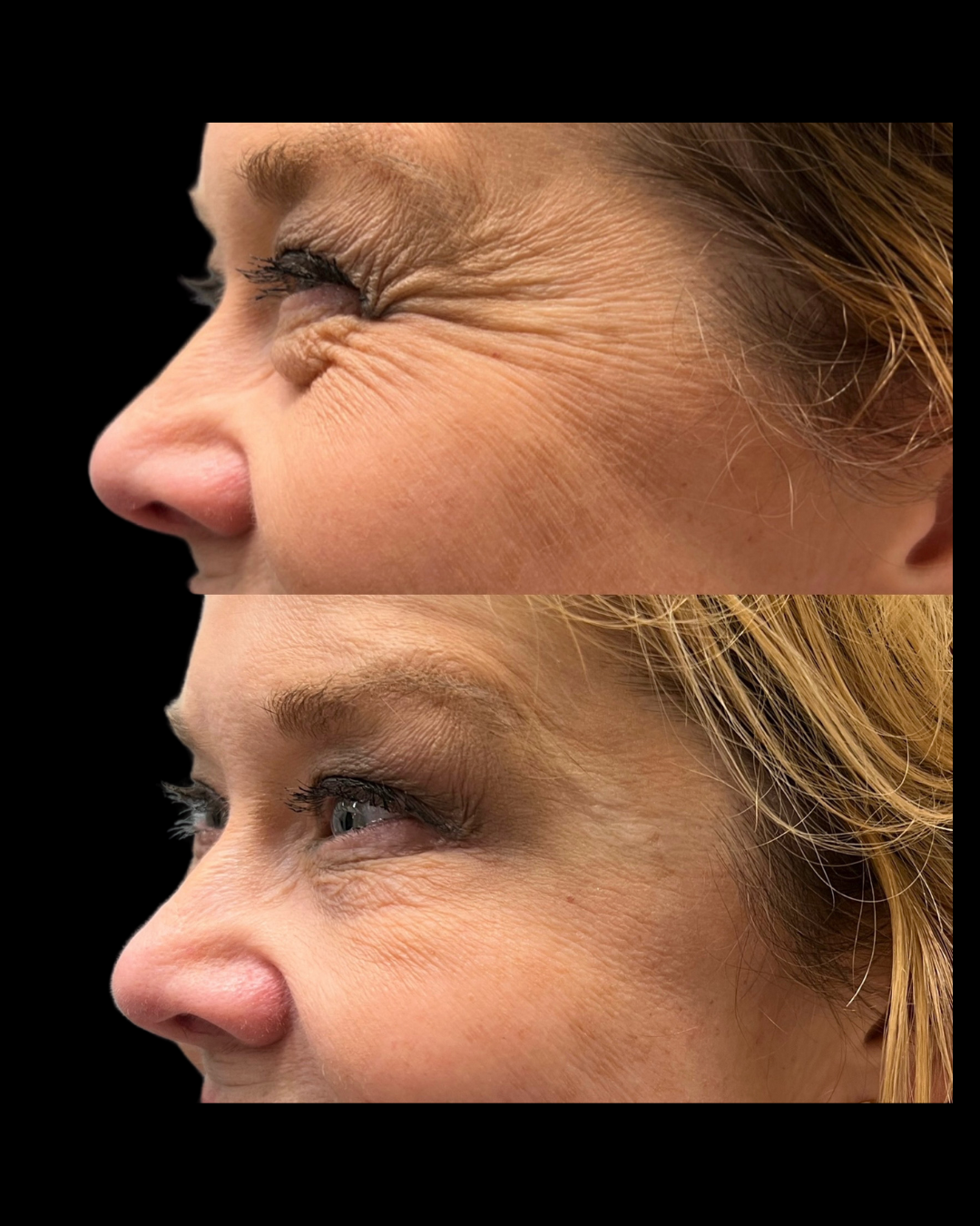Before-and-after results from facial balancing treatments at Maxwell Aesthetics in Salem, Oregon, including Botox, dermal fillers, lip enhancements, and lower face rejuvenation—designed to enhance natural symmetry and restore youthful contours.
