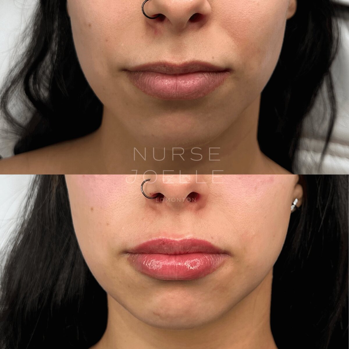 Nurse-Joelle-Cosmetic-Injectables-Before-and-After-15