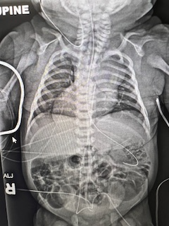 Neonatal xray