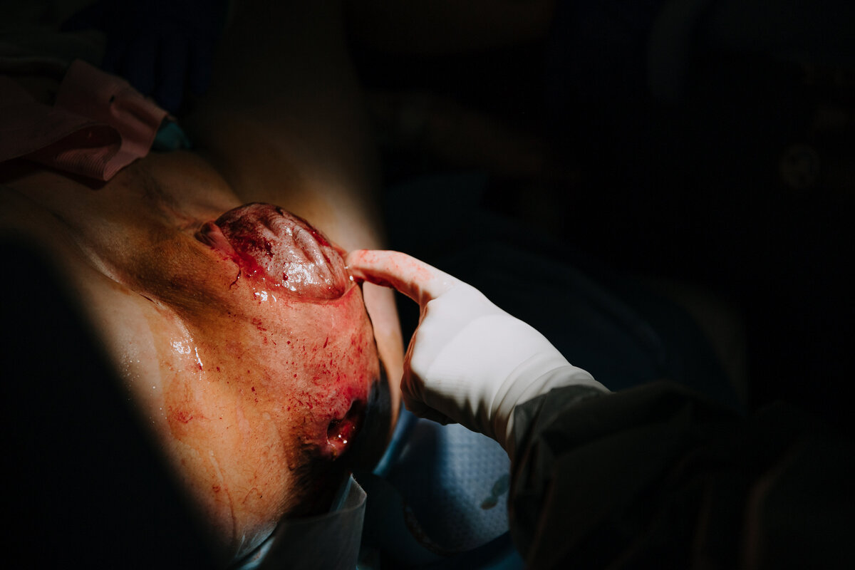 Baby crowns mothers vagina during birth