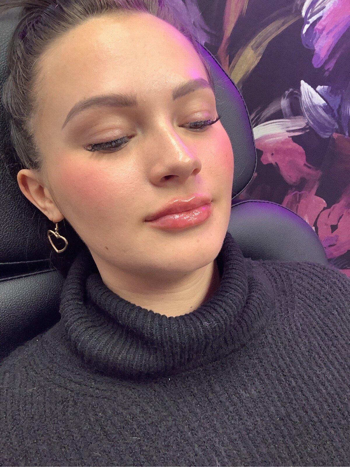 after lip filler