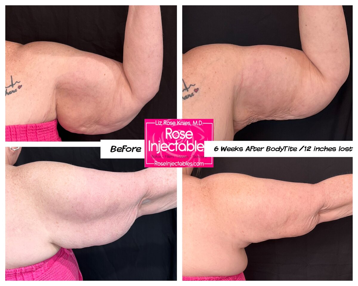 BodyTite-by-Rose-Injectables-Minimally-Invasive-Body-Contouring-Before-and-After-Photos-31