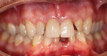 Kirkland teeth before veneers