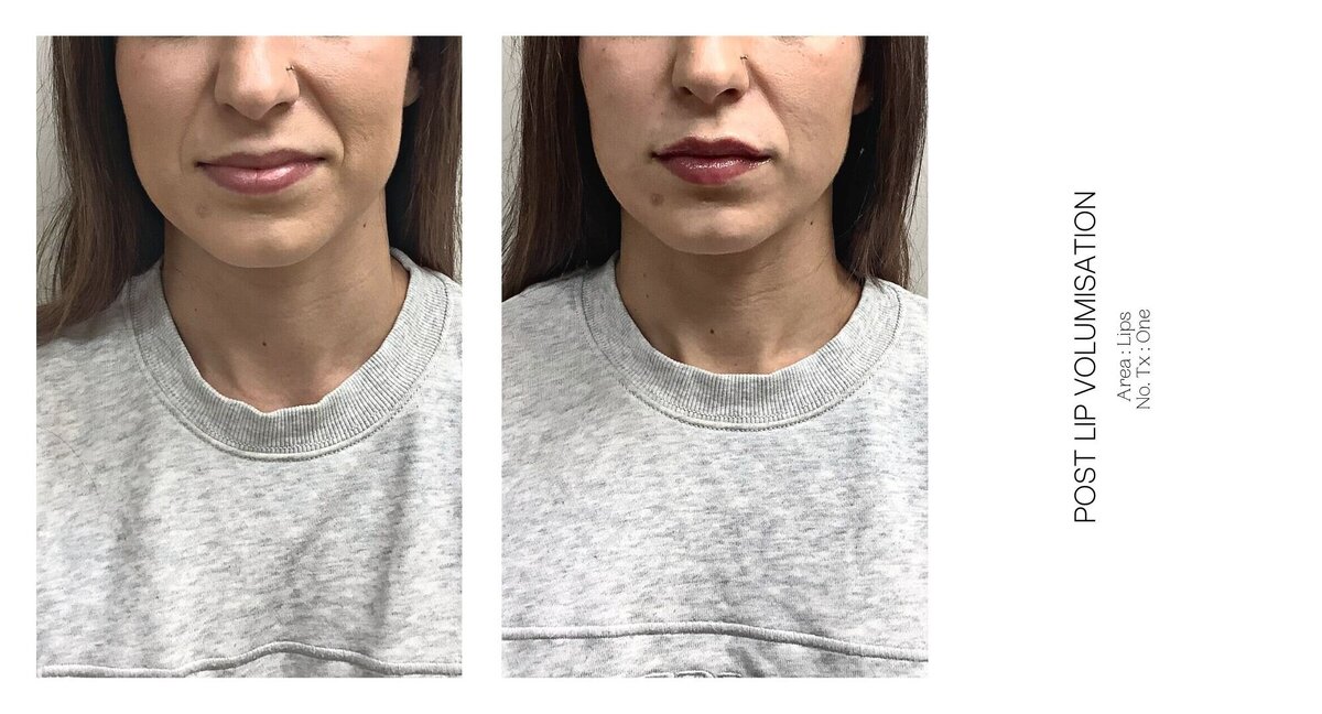 Best South Coast Lip Injection Before and After 2
