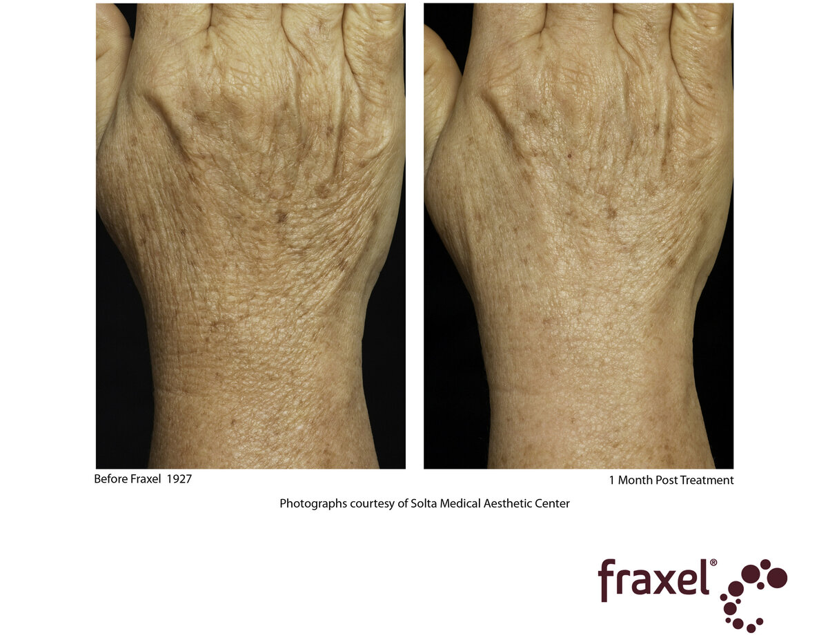 0303-Fraxel_1927_HiRes