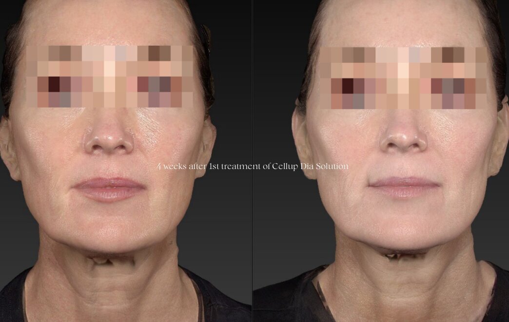 klaride-skin-booster-before-after-3