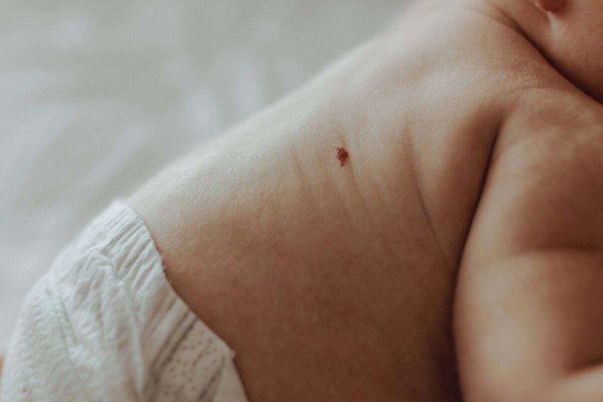 Close-up of a baby’s back showing a small, red birthmark. The baby is wearing a white diaper and lying on a soft surface.
